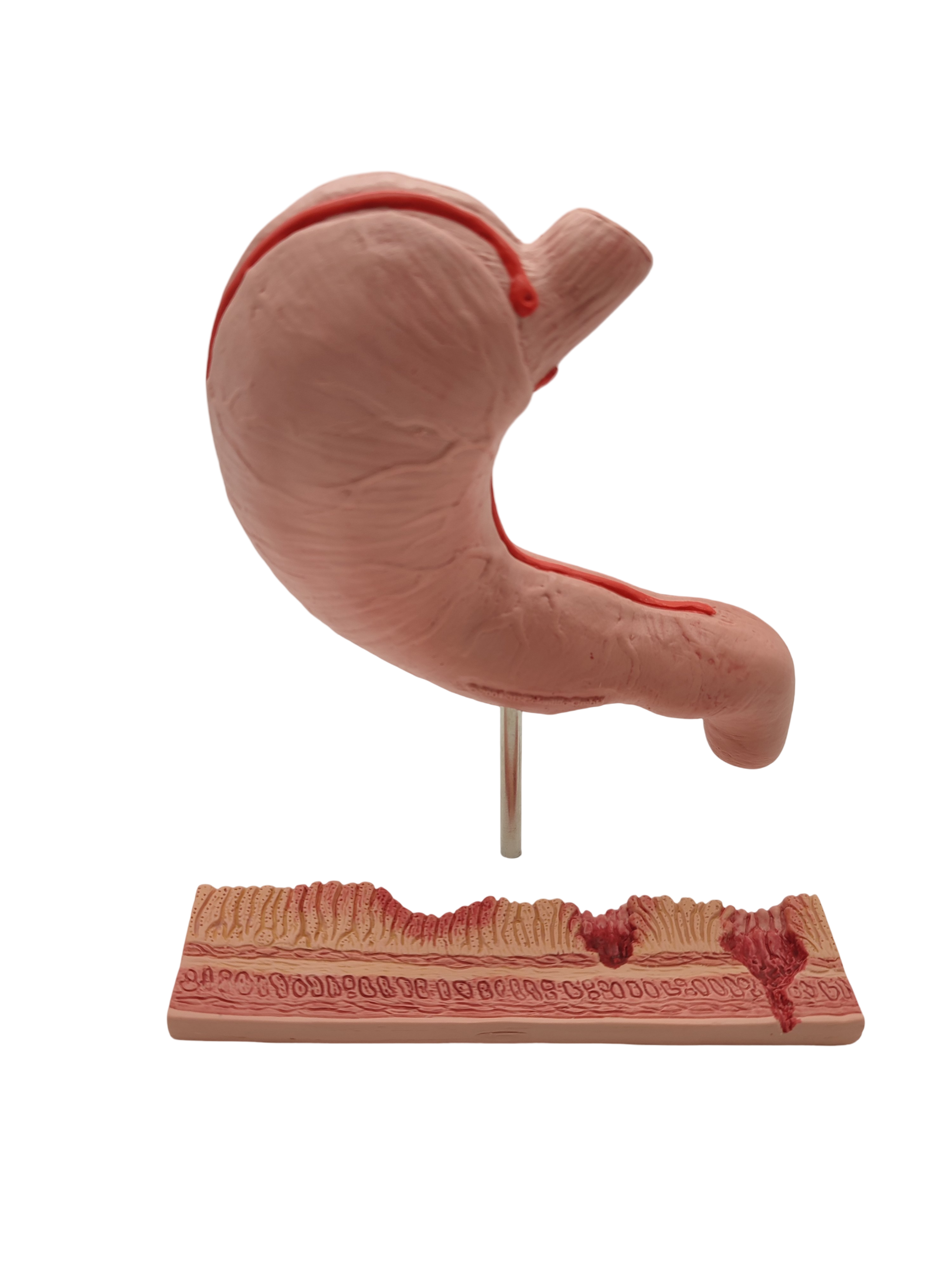 3B Scientific Magenmodell Anatomie mit Geschwüren 3B Smart Anatomy
